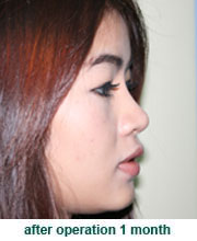 plastic_surgery_augmentation_rhinoplasty